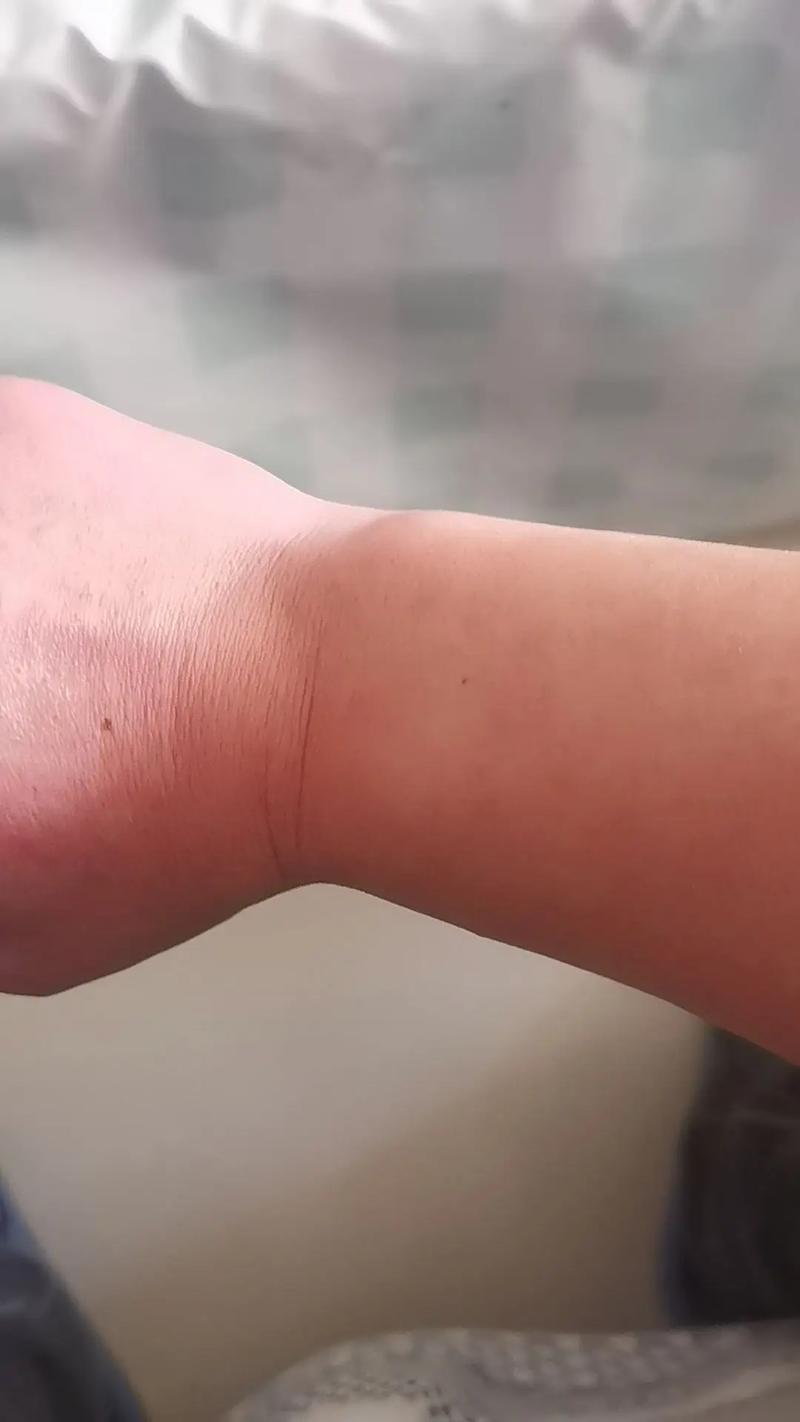 王少杰谈手腕伤势：有些老伤&近期有些复发 之前在场上被撞了一下